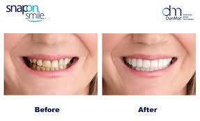Snapon Smile/ veeners/ snap on smile veerners / veeners braces/Snapon Smile Teeth/ Snapon Smile Veeners/ Snapon Smile Artificial Teeth/ silicon braces/ Artificial teeth