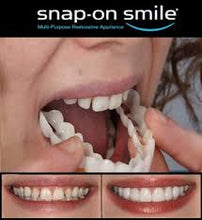 Snapon Smile/ veeners/ snap on smile veerners / veeners braces/Snapon Smile Teeth/ Snapon Smile Veeners/ Snapon Smile Artificial Teeth/ silicon braces/ Artificial teeth
