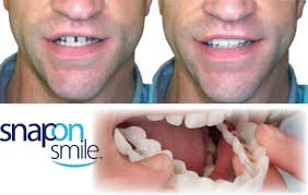 Snapon Smile/ veeners/ snap on smile veerners / veeners braces/Snapon Smile Teeth/ Snapon Smile Veeners/ Snapon Smile Artificial Teeth/ silicon braces/ Artificial teeth
